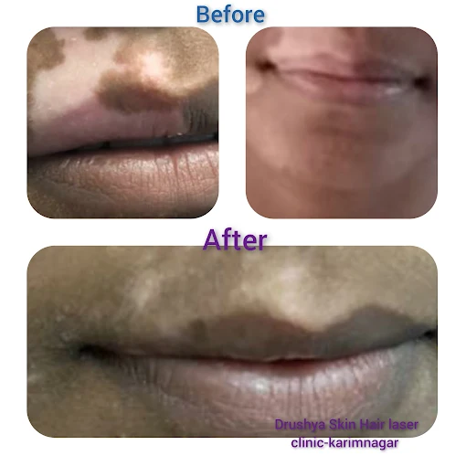 Acne Treatment Result