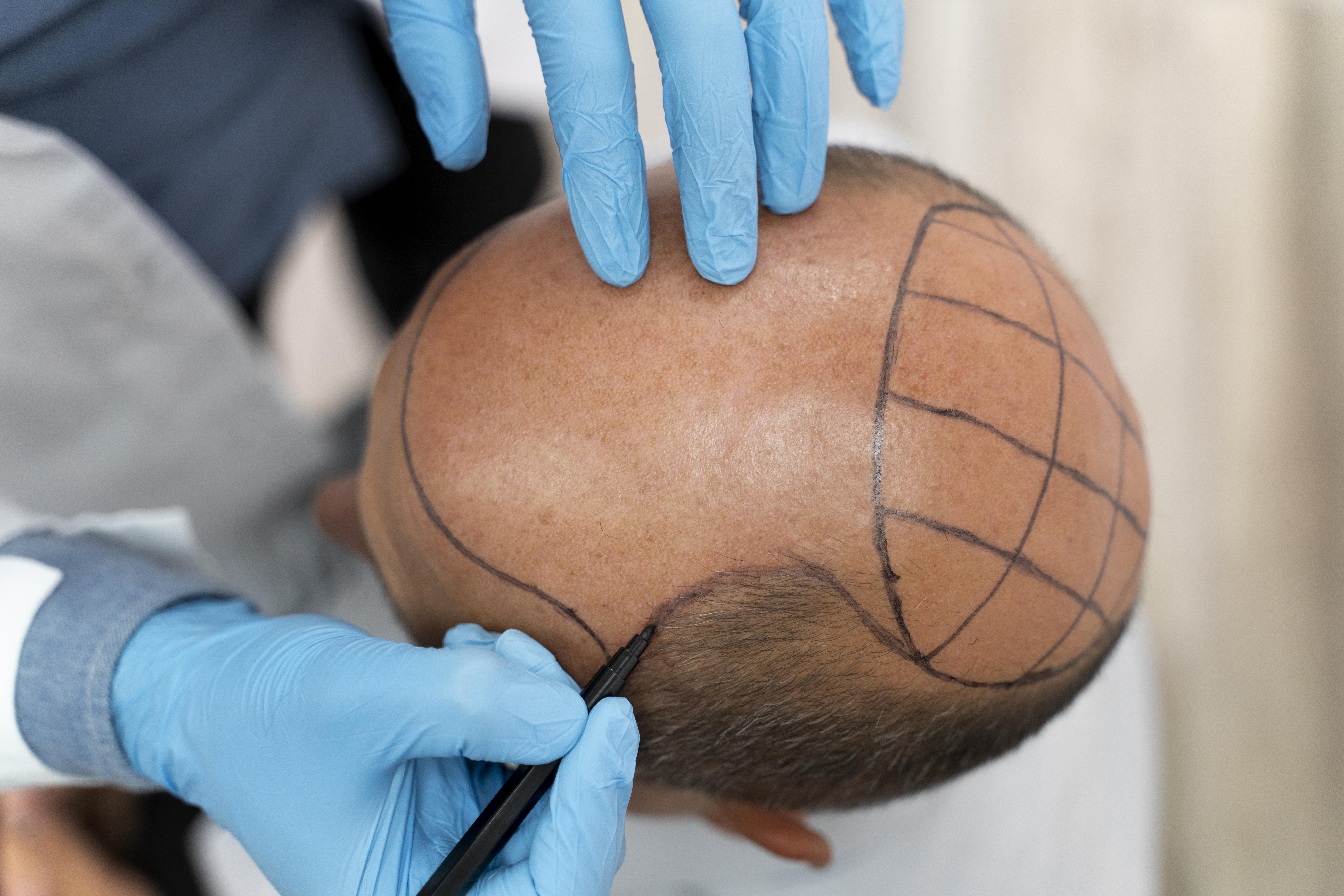 Hair Transplant Bio-FUE